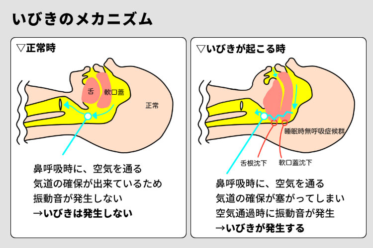 いびきのメカニズムを解説した図。正常時と、舌や軟口蓋が下がって気道が狭くなることでいびきが発生する状態を比較
